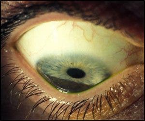 Ojo con queratocono.