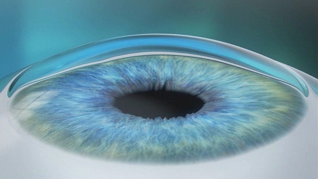 Simulación de ojo operado con técnica PRK. 