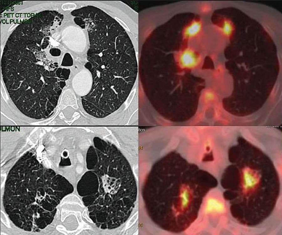 PET para determinar el alcance del cáncer pulmón