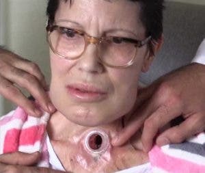 Flora Bernal, de 59 años, durante la presentación de su operación de laringe en el Hospital Trueta de Girona en España. Una operación que ha permitido a especialistas extraer por vía oral la laringe afectada por un tratamiento de radioterapia, para colocarle posteriormente una prótesis.