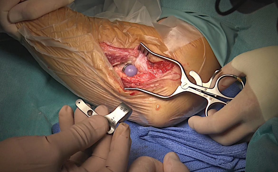 Placa de ajuste articular y cabeza radial de prueba-efe