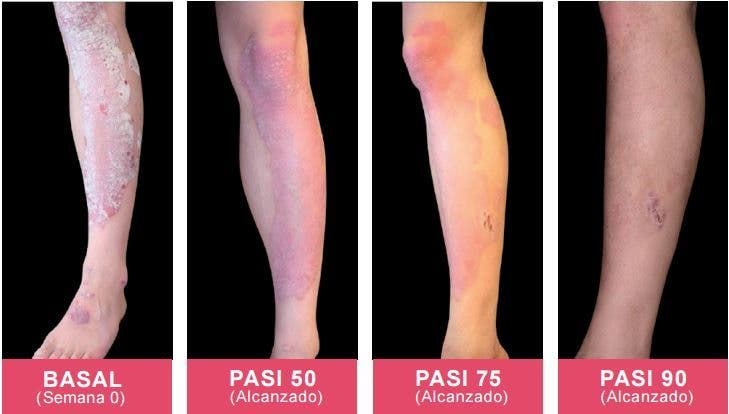psoriasis