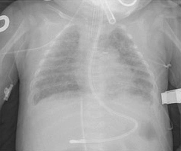Pulmones incompetentes de un bebé prematuro.