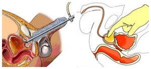 RTUP y adenomectomía