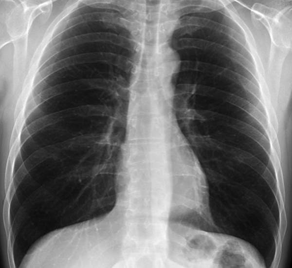 Radiografía de pulmones sin cáncer