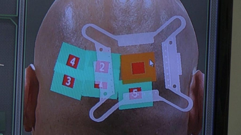 Imagen digital de una nuca de persona sin pelo, en la que se muestran las zonas de donde el robot Artas ya ha extraído los folículos capilares. efe