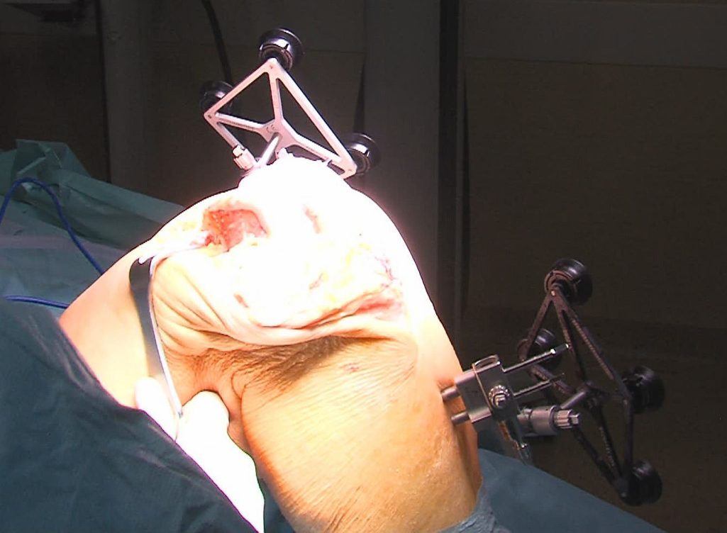 Rodilla abierta con antenas Mako-efe