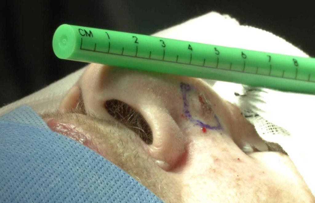 Medición del tamaño de un tumor basocelular en la nariz.