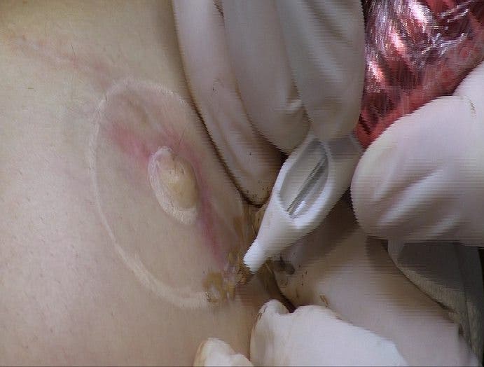 Tatuaje sobre el borde de la areola de la mama izquierda.