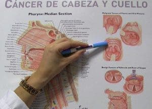 zonas donde aparece el cáncer de cabeza y cuello.