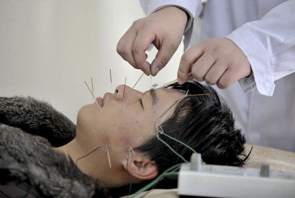 Acupuntura