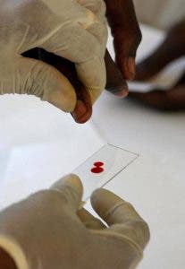 anemia hemolítica análisis