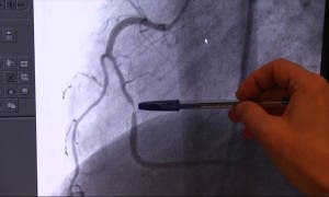 angioplastia Macaya