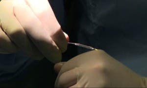 angioplastia BALÓN