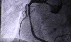 angioplastia Macaya