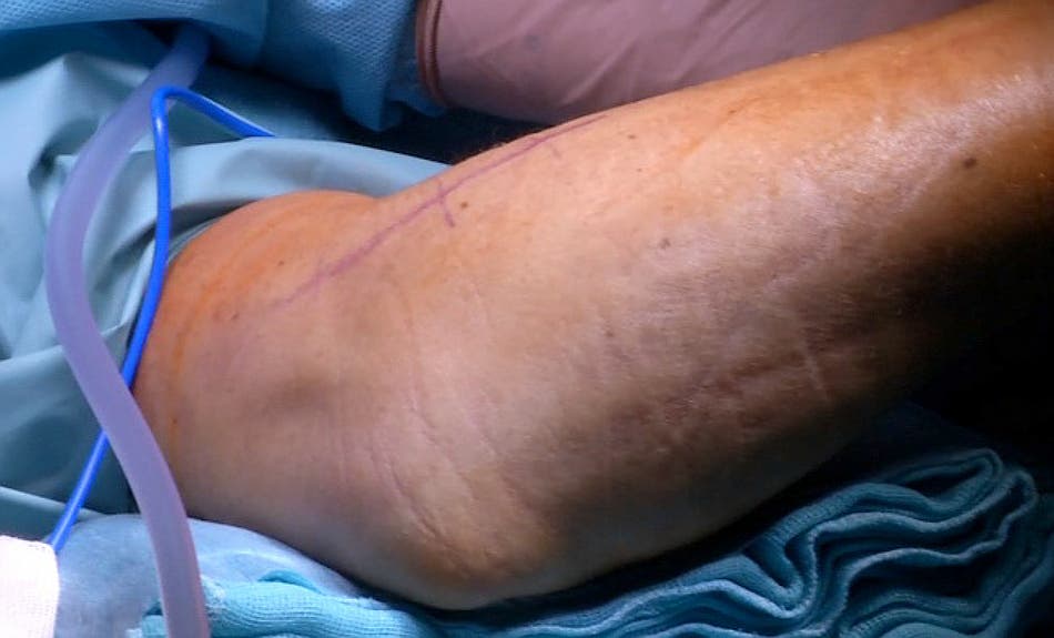 Antebrazo y codo de una paciente en el quirófano