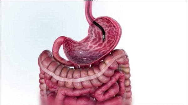 cáncer gastríco