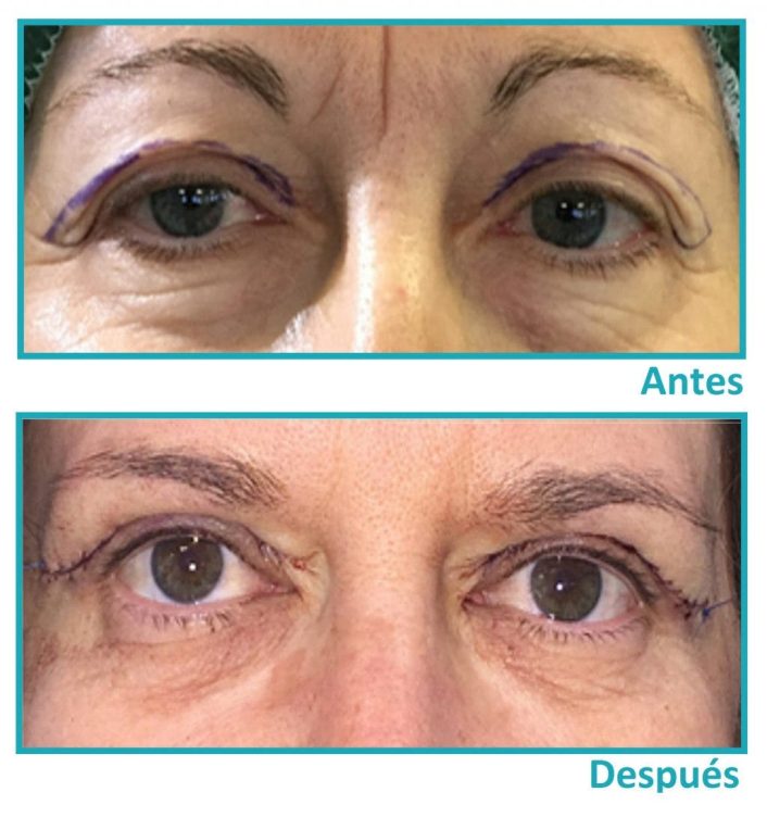 Párpados y ojos antes y después de una cirugía de blefaroplastia.