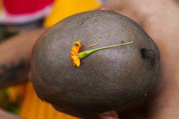 Alopecia