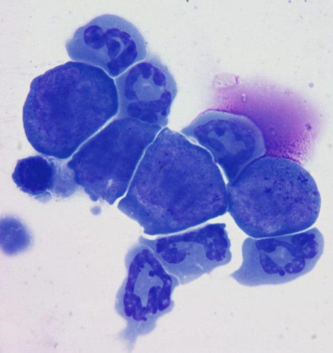 cáncer azar