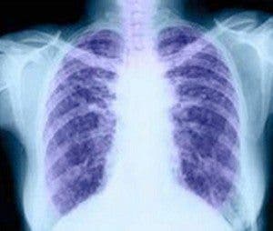 Cáncer de pulmón