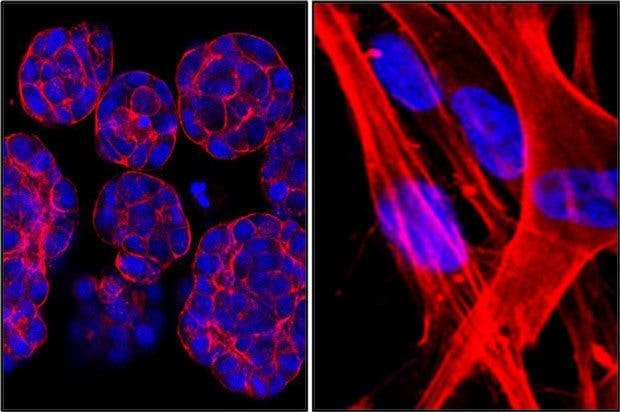 Células cancerígenas