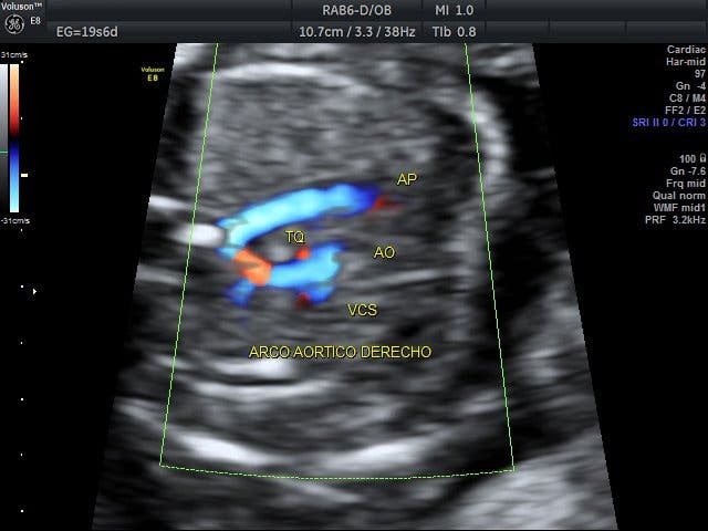 cardiopatía congénita