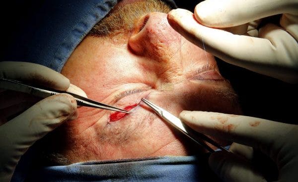 oculoplastia