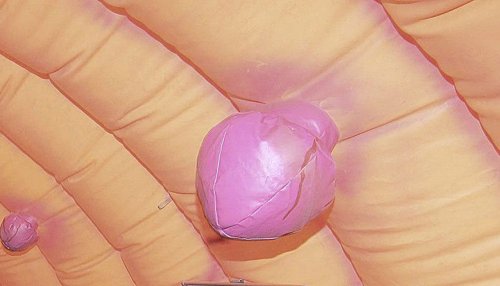 Cáncer de colon, colon, salud, hábitos saludables, alimentación, ejercicio, dolor, diagnóstico, colonoscopia, hemorragia, digestivo, tumores, pólipos, mortalidad, oncología, síntomas