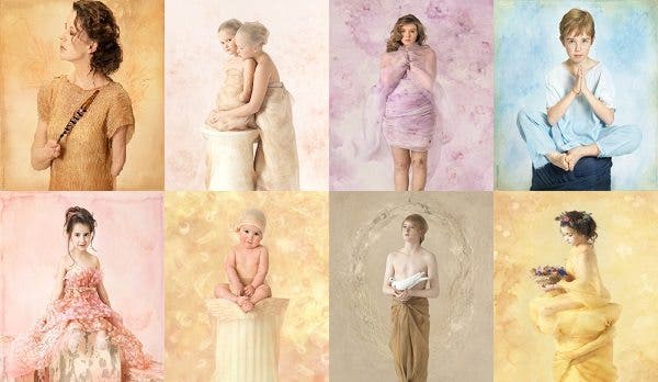 Fotografía meningitis