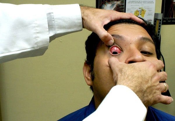 ¿Qué es la conjuntivitis? EFE /Ulises Rodrìguez.