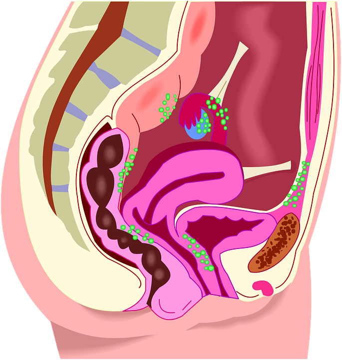 síntomas endometriosis