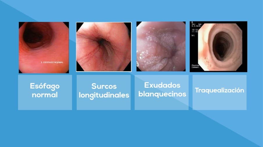 Esofagitis, eosinofílica, disfagia, dolor, comida, comedor, malnutrición, estados, normal, traquealización