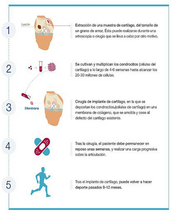 Esquema de Regeneración celular de cartílago