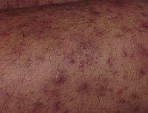 foliculitis