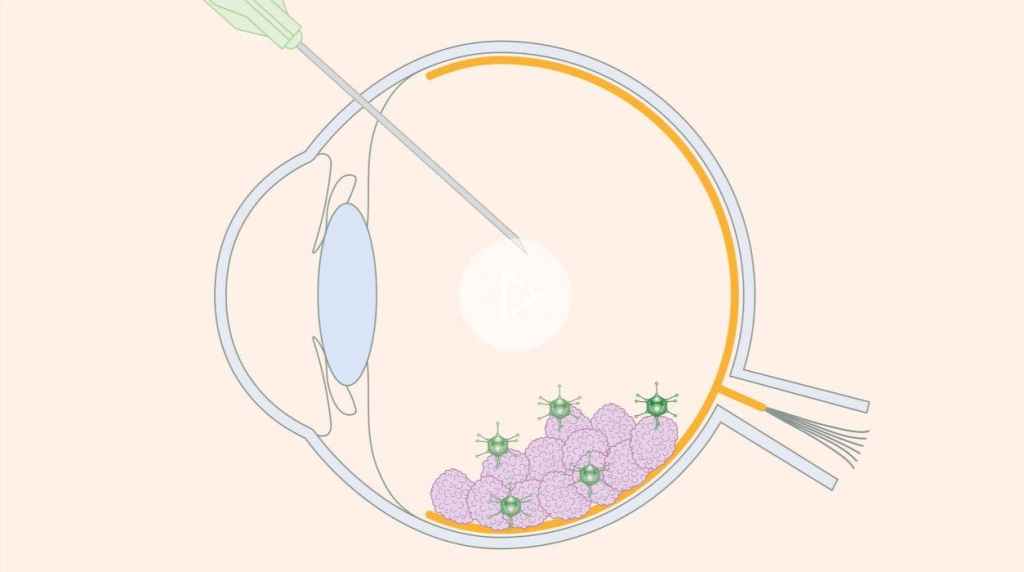 cáncer de ojos