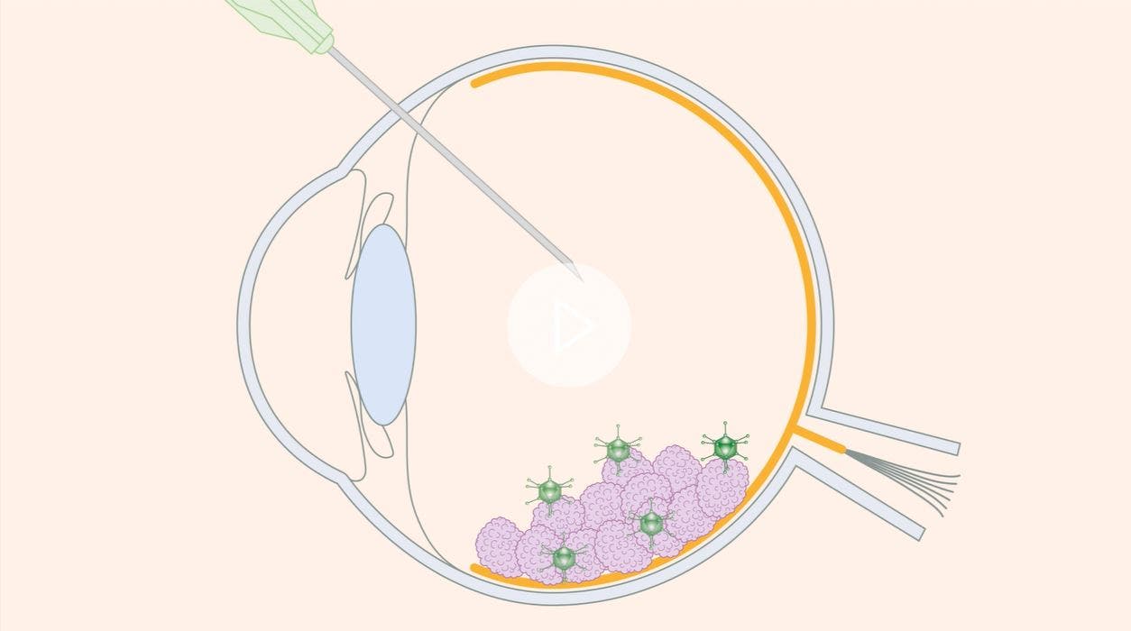 cáncer de ojos