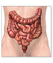 personas ostomizadas