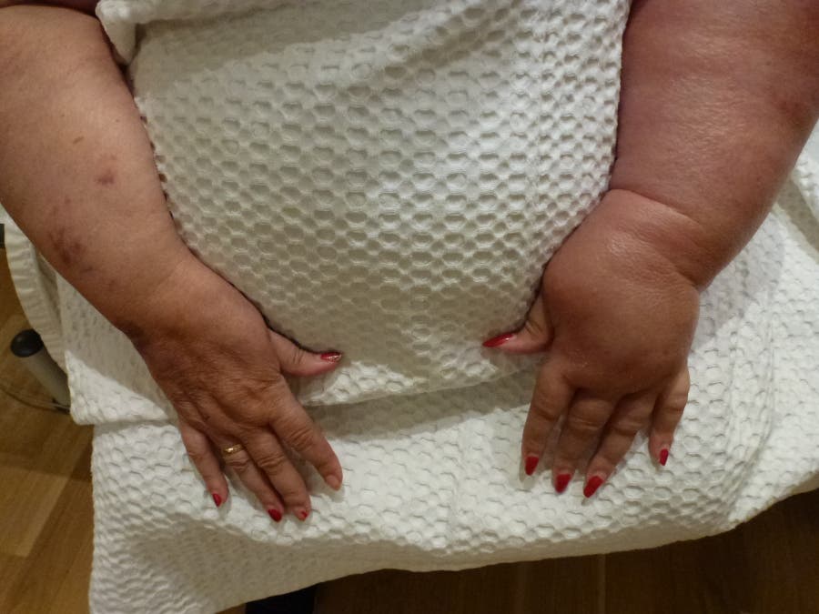 linfedema, brazos, mano, mujer, enfermedad, Día Mundial del Linfedema, tratamiento, diagnóstico, pacientes, oncológicos