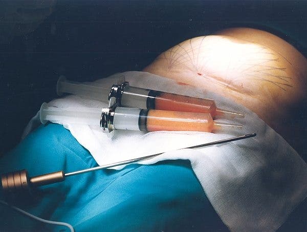Imagen de materiales para intervención de liposucción. Efesalud.com
