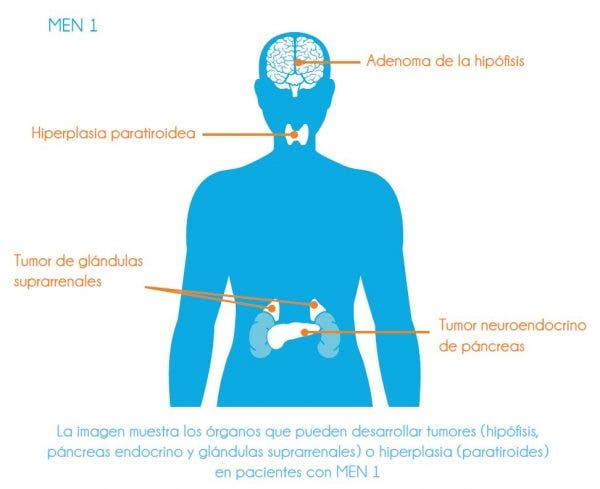 tumor neuroendocrino páncreas