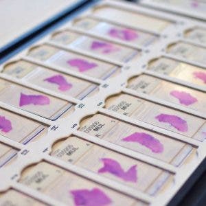 Muestras de ADN humano obtenido por biopsia líquida