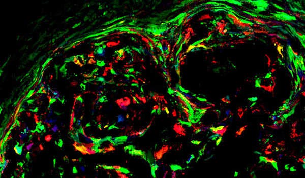 células pintadas de osteosarcoma