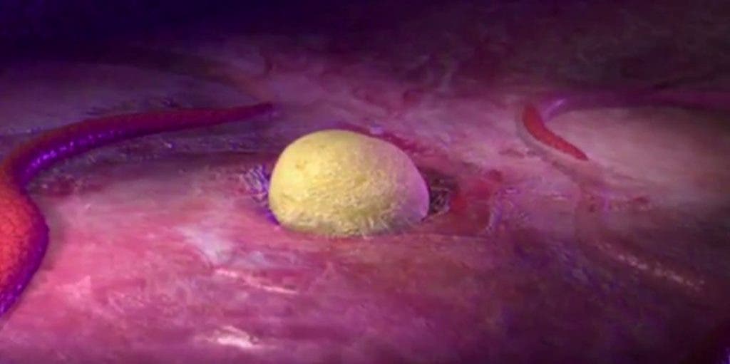 cáncer de ovario