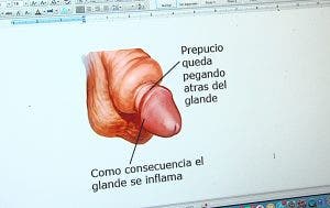 Dibujo de un pene con parafimosis.