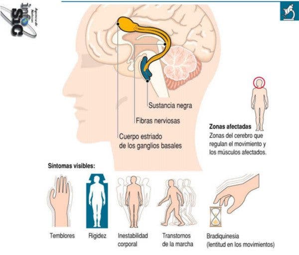 Parkinson infografía