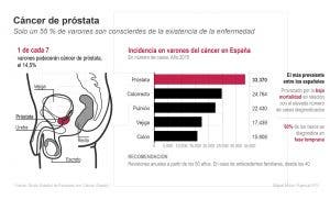 cancer de prostata