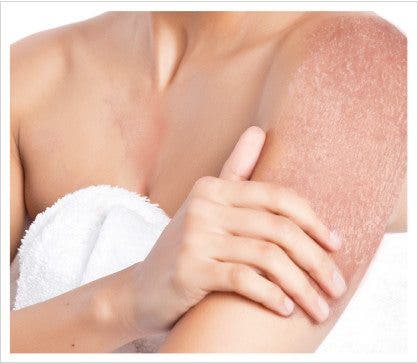 Efecto de la psoriasis en el brazo de una mujer. Efesalud.com