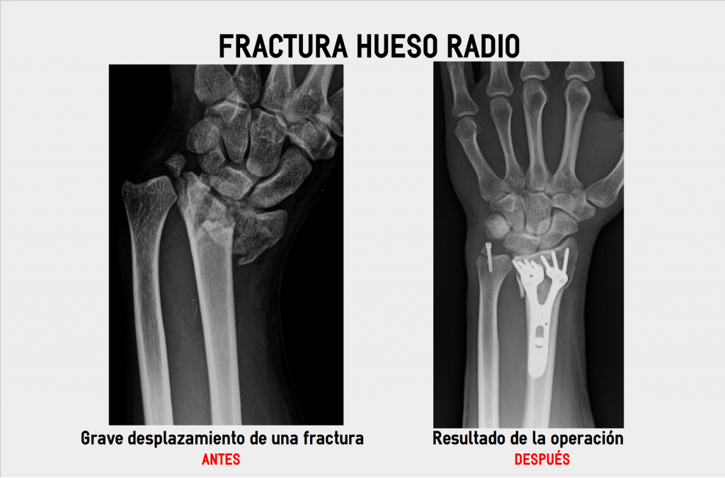 radio hueso