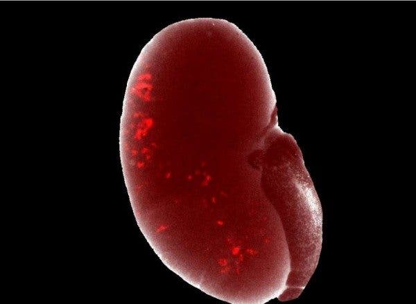 pacientes renales pandemia